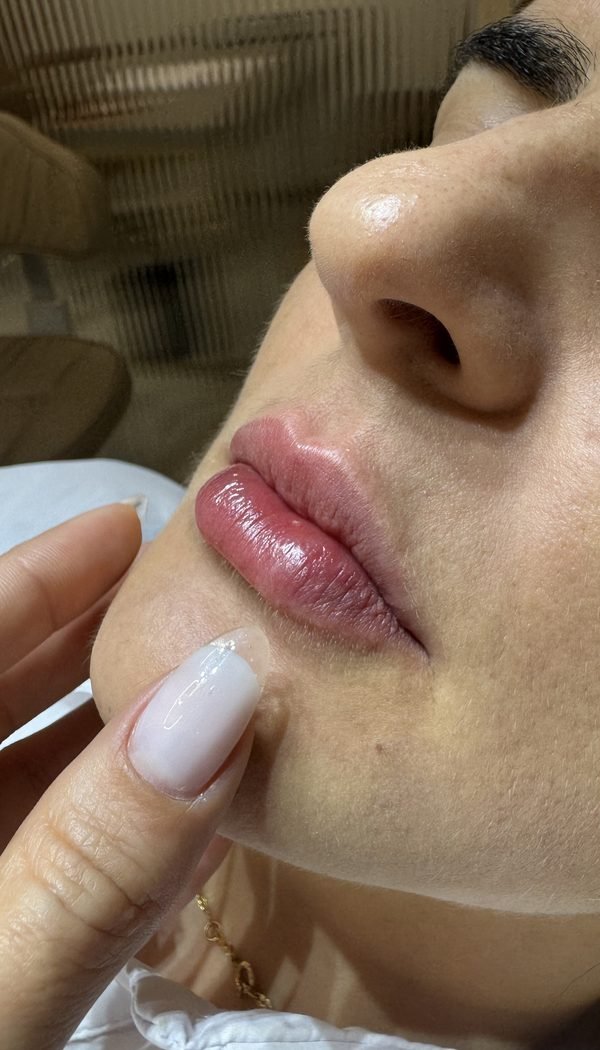 Preenchimento labial — volume natural